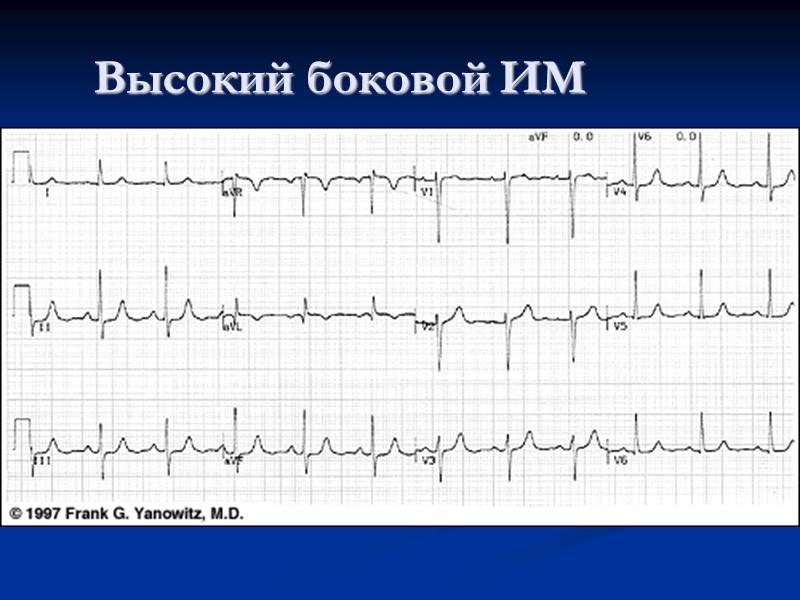 Высокий боковой ИМ